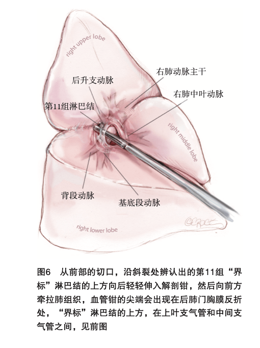 胸腔镜肺叶切除及肺段切除手术图谱｜胸部疾病肺段切除_手机搜狐网