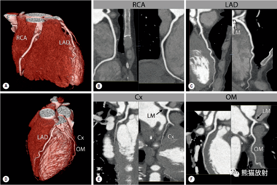 格艾选读丨冠状动脉ct相关概念解剖