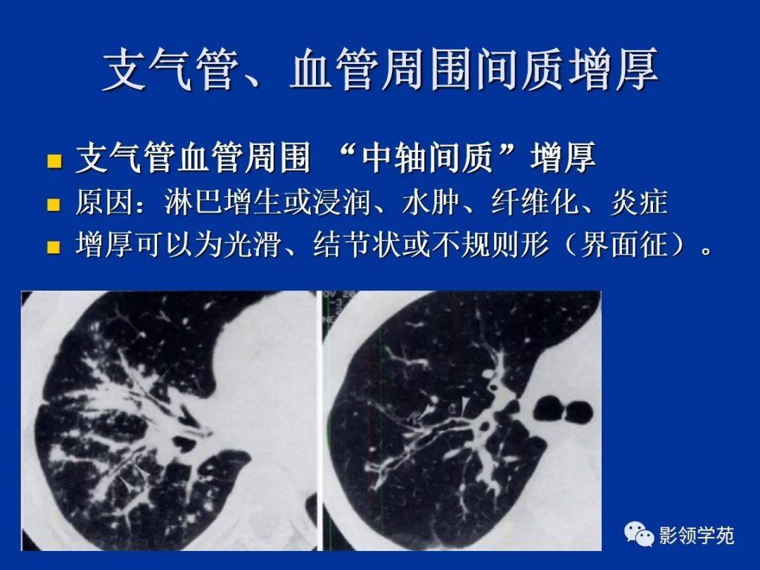 肺小叶,肺间质解剖与病变的hrct诊断_支气管