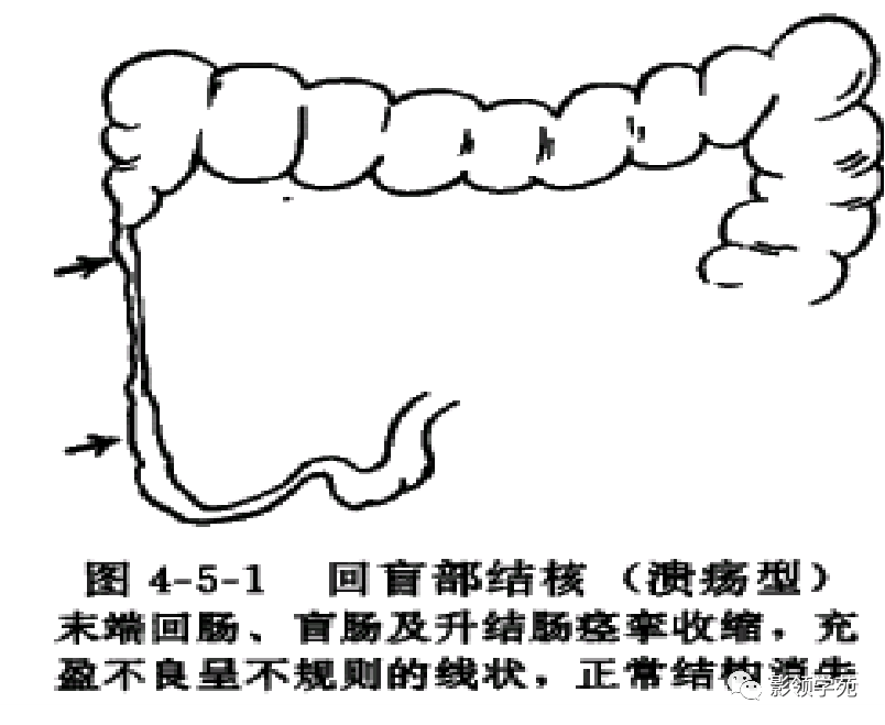 推荐丨回盲部解剖特点及其病变的影像诊断!