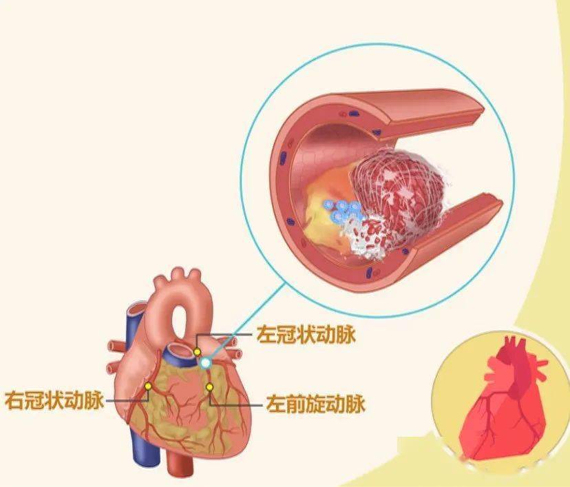 死是指冠状动脉突然闭塞，导致心肌持续性缺血缺氧，从而引起心肌坏死。