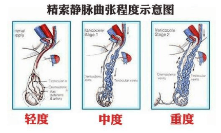 南医三院泌尿外科副主任医师周其赵介绍,精索静脉曲张是指阴囊内精索