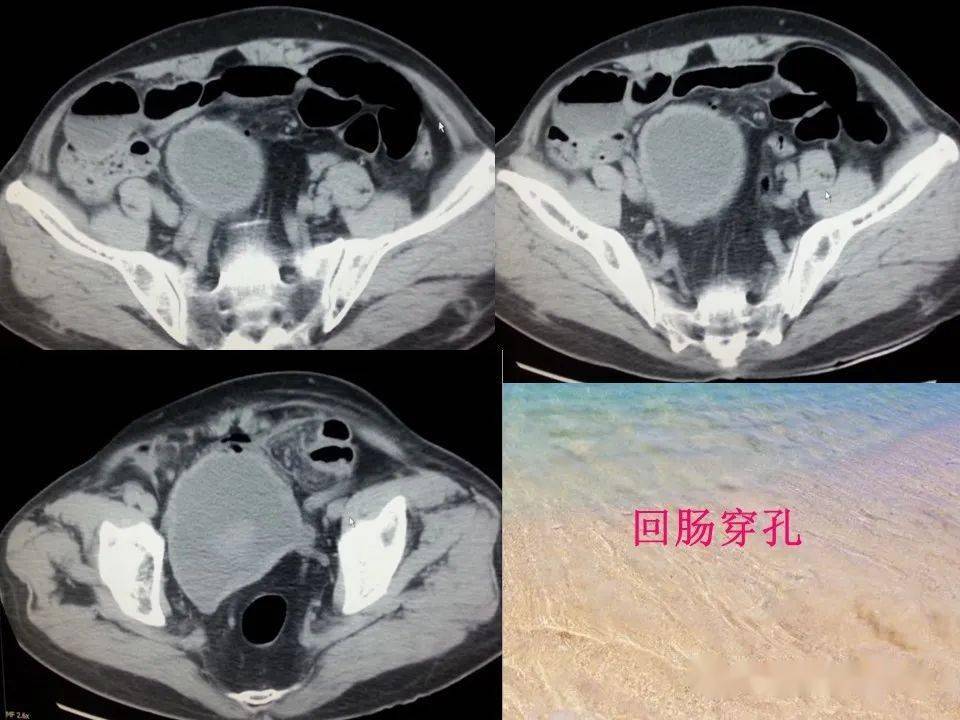 消化道穿孔的ct诊断