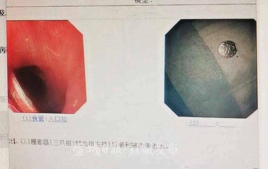 幼童|12小时未能进食！宣城2岁幼童误食了它