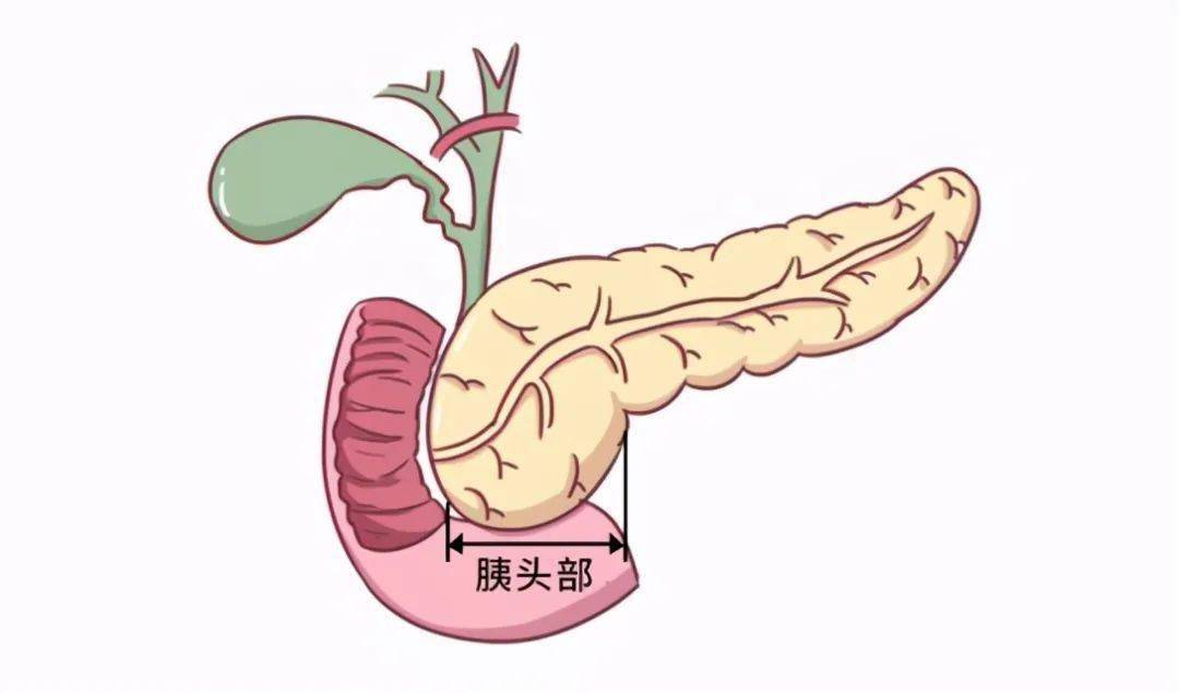 胰腺肿瘤长大紧邻脊柱胰腺在腹膜后方但胰腺癌的症状也可能是这个谁还