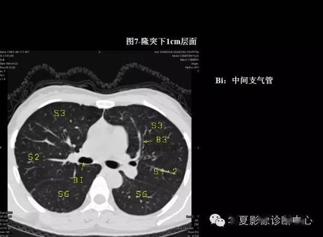 肺部感染ct太难学看完这篇干货不信你还不会