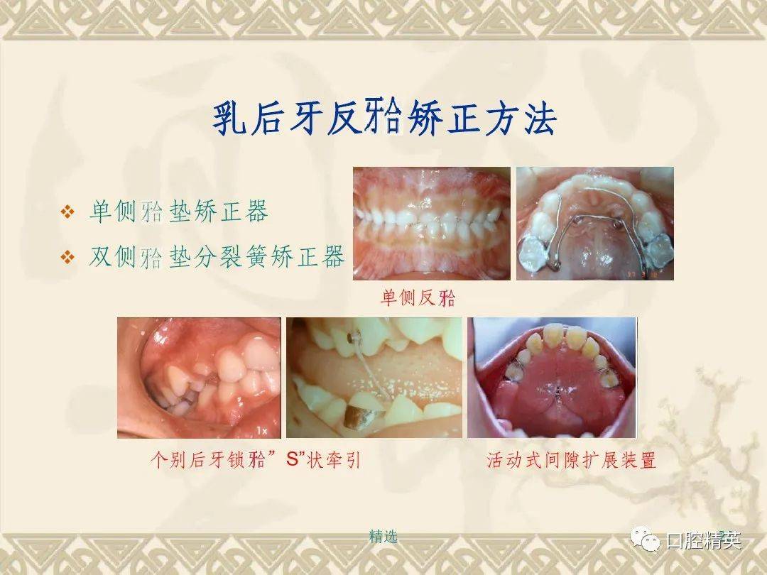 间隙保持器的设计和制作