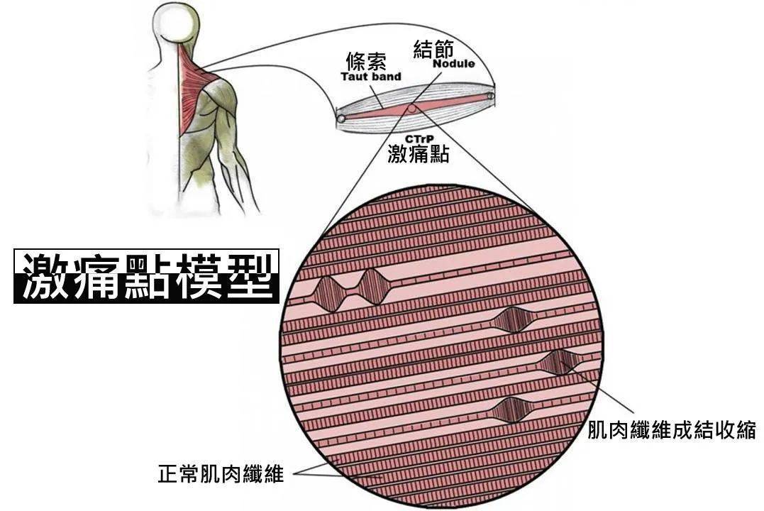 产生mps肌筋膜疼痛主要是因为肌肉  持续收缩,如工作时重复做一个动作