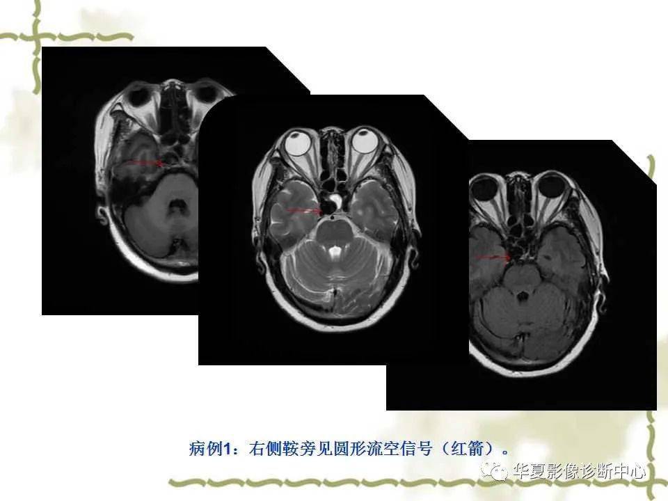 海绵窦解剖及常见疾病的影像诊断