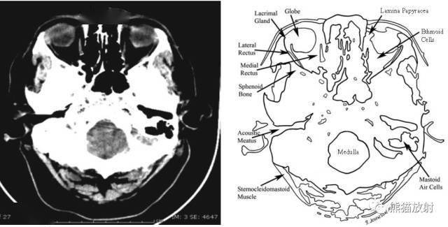 颅脑ct的正常解剖_大脑