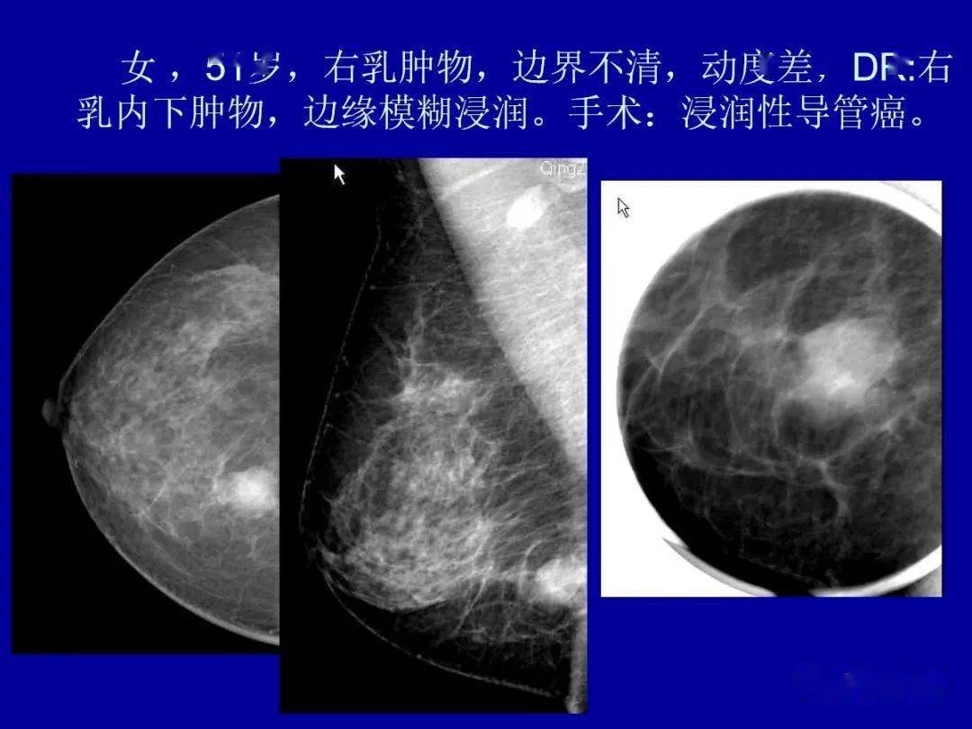 乳腺癌的影像诊断