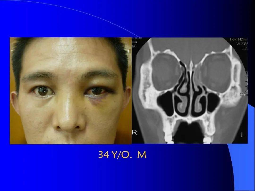 眼和眼眶的影像学诊断_肿瘤