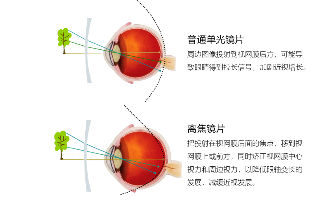 中心视力稳定清晰,防止模糊及矫正不足引起的形觉剥夺导致的近视加深