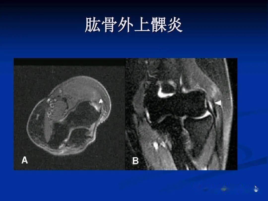 肘关节mri图谱超全整理及常见病变mr诊断