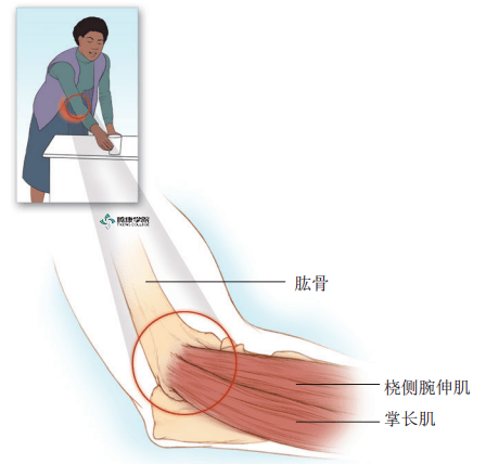 疼痛解剖学网球肘