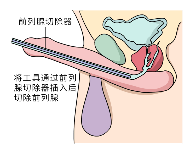 有可能会出现  尿失禁的情况