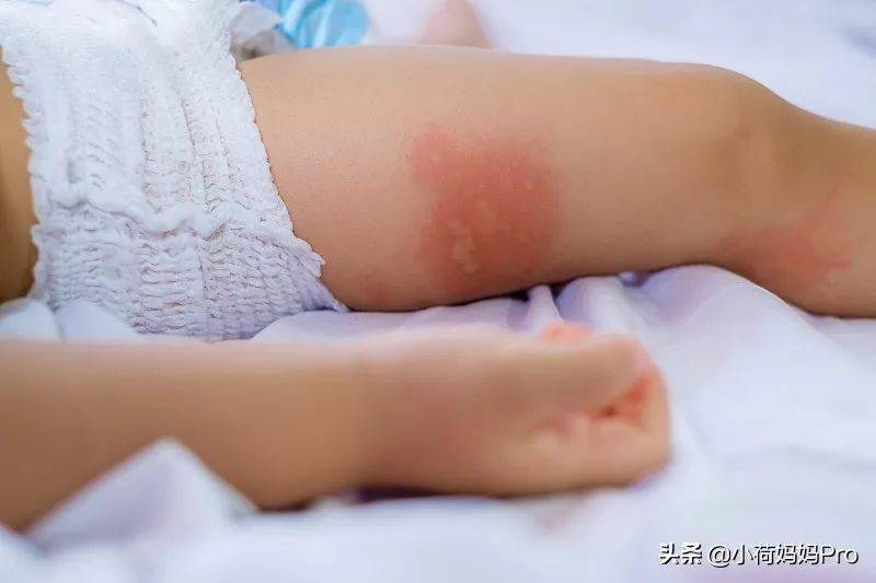 身上瘙痒是怎么回事儿 185ec3c1ef254134b37bfe205bb3bae7.jpeg