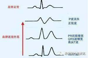 高钾血症:临床关注的心电图问题