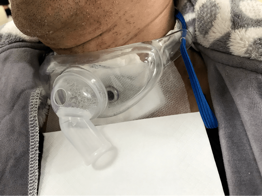 气管切开术即切开颈段气管,放入金属气管套管或硅胶套管,是解除喉源性