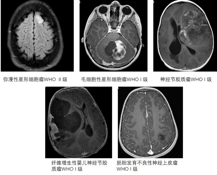 【精选编译】儿童低级别胶质瘤