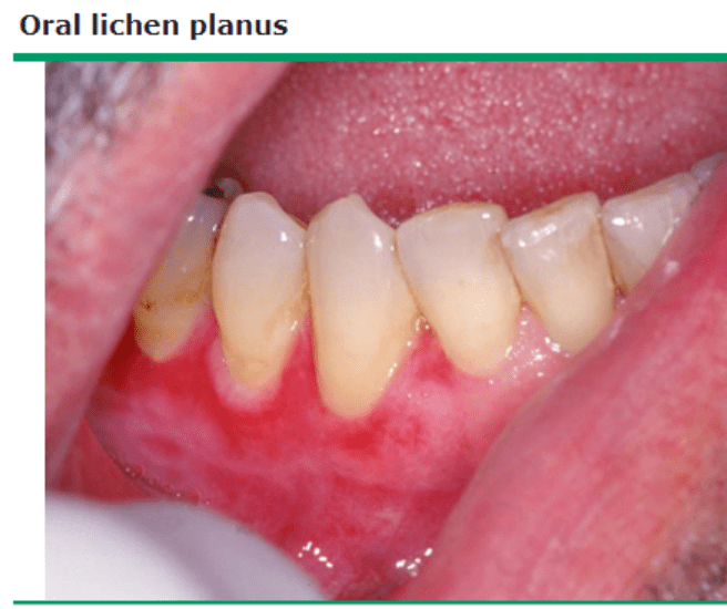 口腔扁平苔藓患者牙龈红斑和糜烂6口腔盘状红斑狼疮(dle)15%-20%的dle
