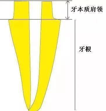 【牙医必备】纤维桩的临床操作 流程步骤详解