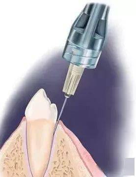 【注意】口腔局部麻醉,这些事项大意不得!