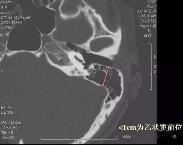 市广丰区裕丰医院放射科诸老师提供) 上图所示解剖变异叫做乙状窦前位