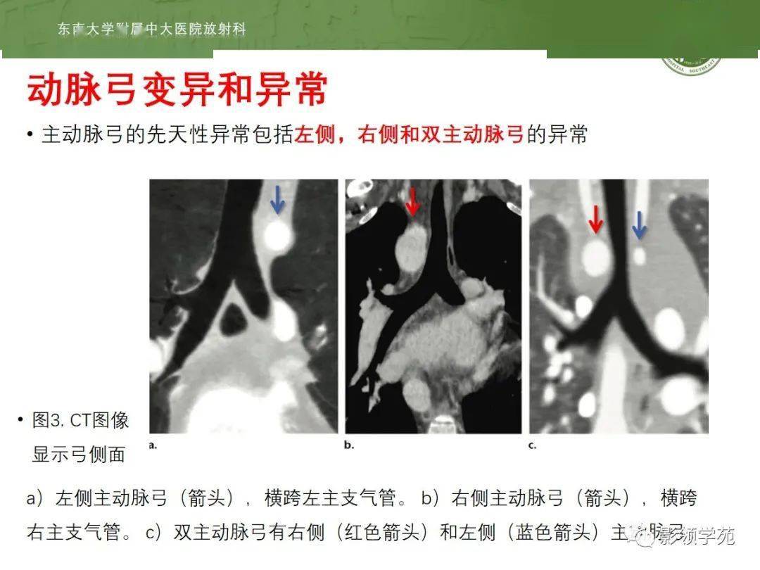 主动脉弓先天变异和异常影像表现