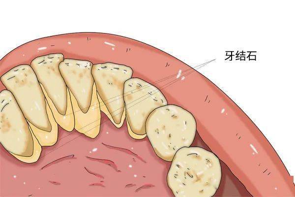 有传言说牙结石如果不洗掉,长期或造成牙齿脱落,这是真的吗?