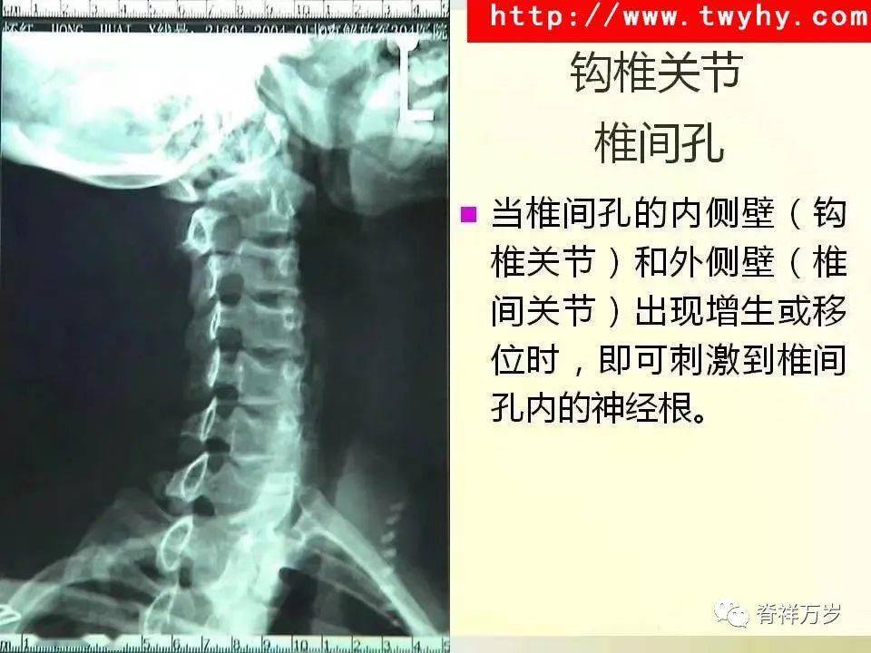 颈椎生理曲度变直