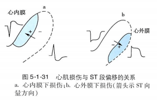 心内膜下心肌损伤时,st向量背离心外膜面指向心内膜,使位于心外膜面的