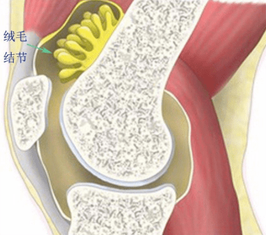 治疗膝关节滑膜炎,微创关节镜显身手!