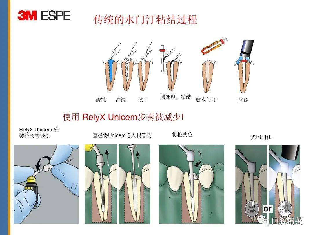 芬力纤维桩everStick POST（直径0.9mm、1.2mm、1.5mm） - 芬力（上海）医疗
