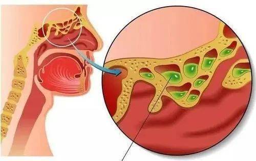 但鼻炎和鼻窦炎有明显的区别,鼻炎仅仅是鼻腔黏膜发生炎症,而鼻窦炎是