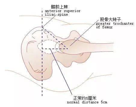 bryant三角:患者仰卧位,自髂前上棘与床面作一垂线,自大粗隆顶点与