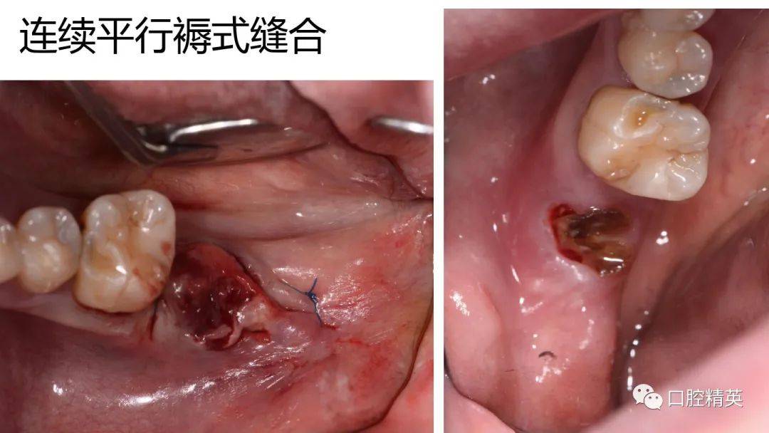 牙科常用缝合方式