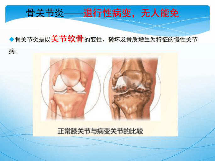 【医文医话】骨二科:膝骨关节炎的阶梯治疗(一)_疾病