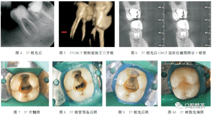 下颌第二磨牙3牙根伴近中3根管1例