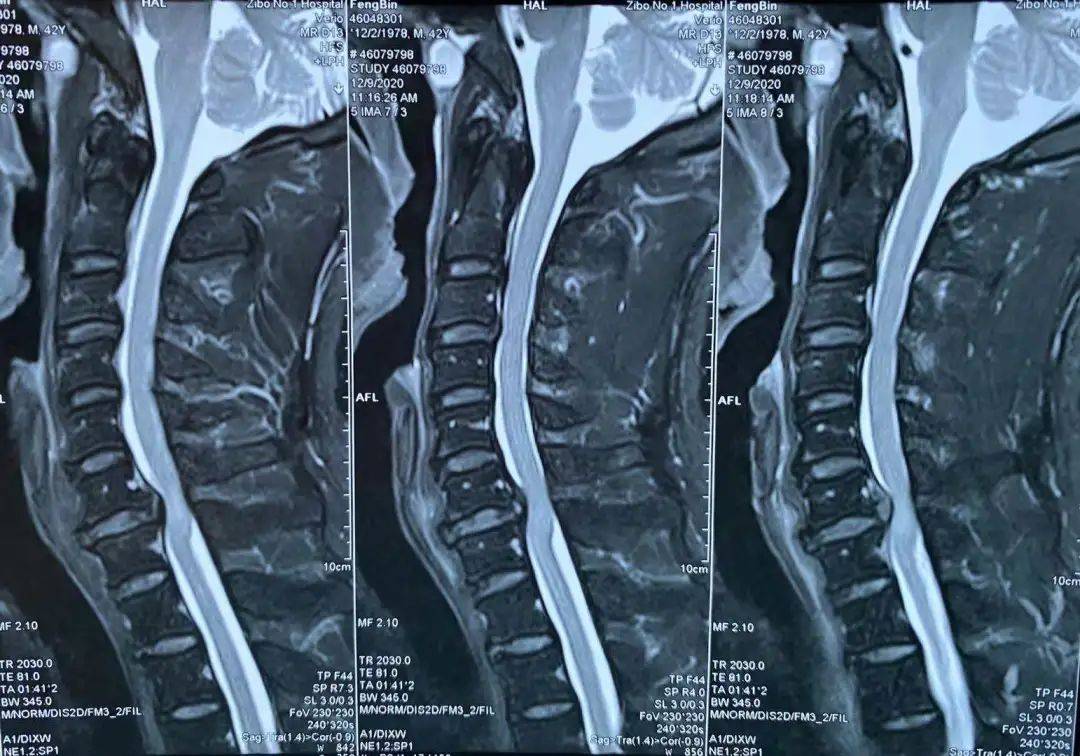 医院骨二科管廷进医生介绍,颈椎融合术是治疗下颈椎间盘退行性疾病