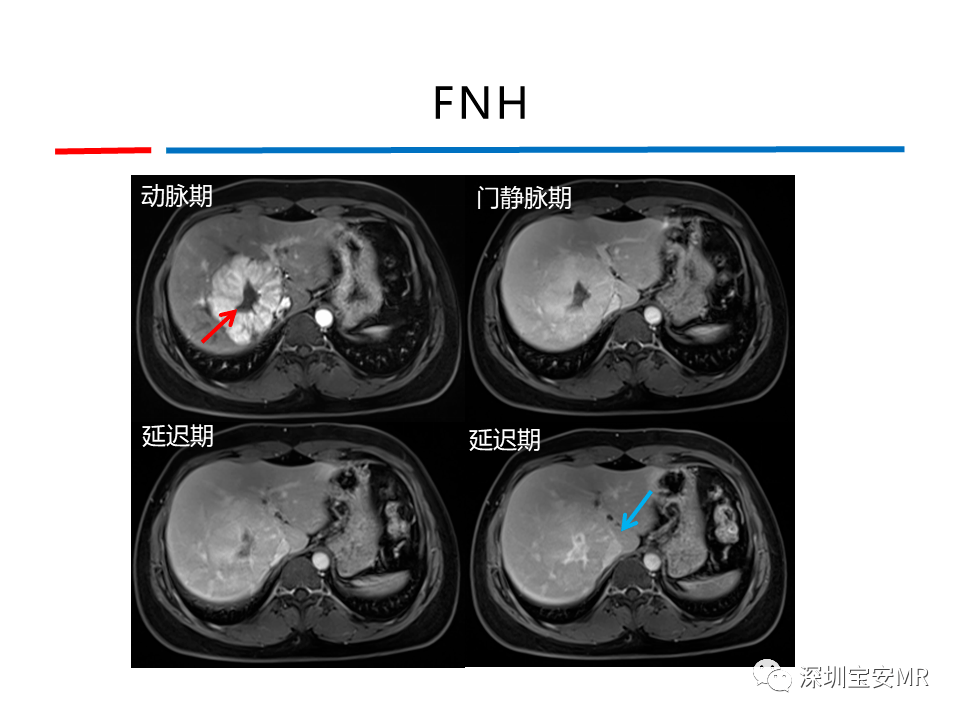 肝脏常见肿瘤mri诊断与鉴别诊断