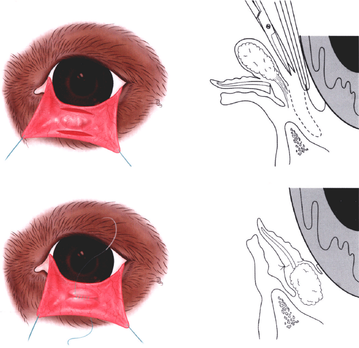 第三眼睑袋状包埋术