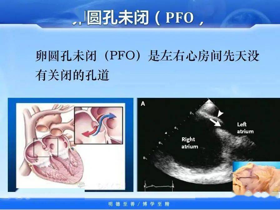 但研究发现成年人中25%即每4人中就有1人卵圆孔未完全闭合,称之卵圆孔