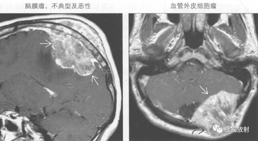 髓外造血