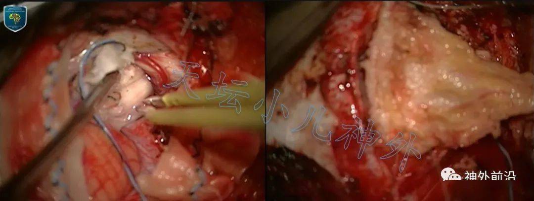 专访宫剑:儿童chiari畸形的天坛小儿神外诊疗策略(下)-术式与案例视频