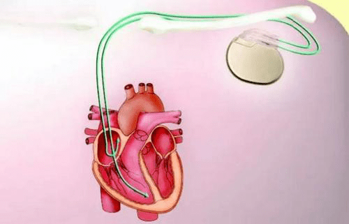 我院为93岁高龄患者成功植入双腔心脏起搏器