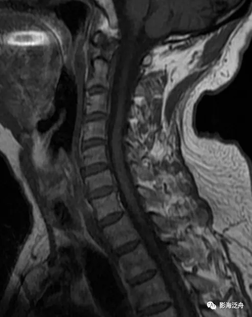 典型病例——颈椎后纵韧带钙化(mr)