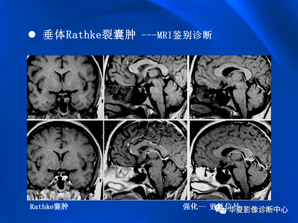 影像拉克氏囊肿的mri表现及鉴别诊断