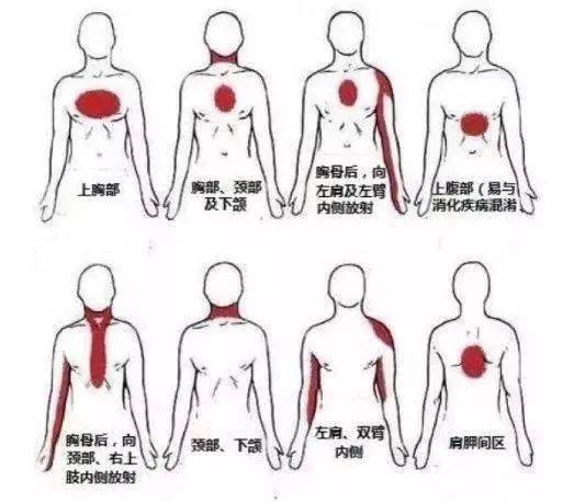 心梗发作的常见疼痛区(图片来自网络)