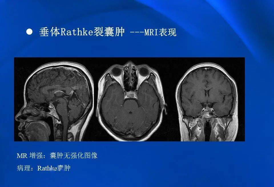 影像拉克氏囊肿的mri表现及鉴别诊断